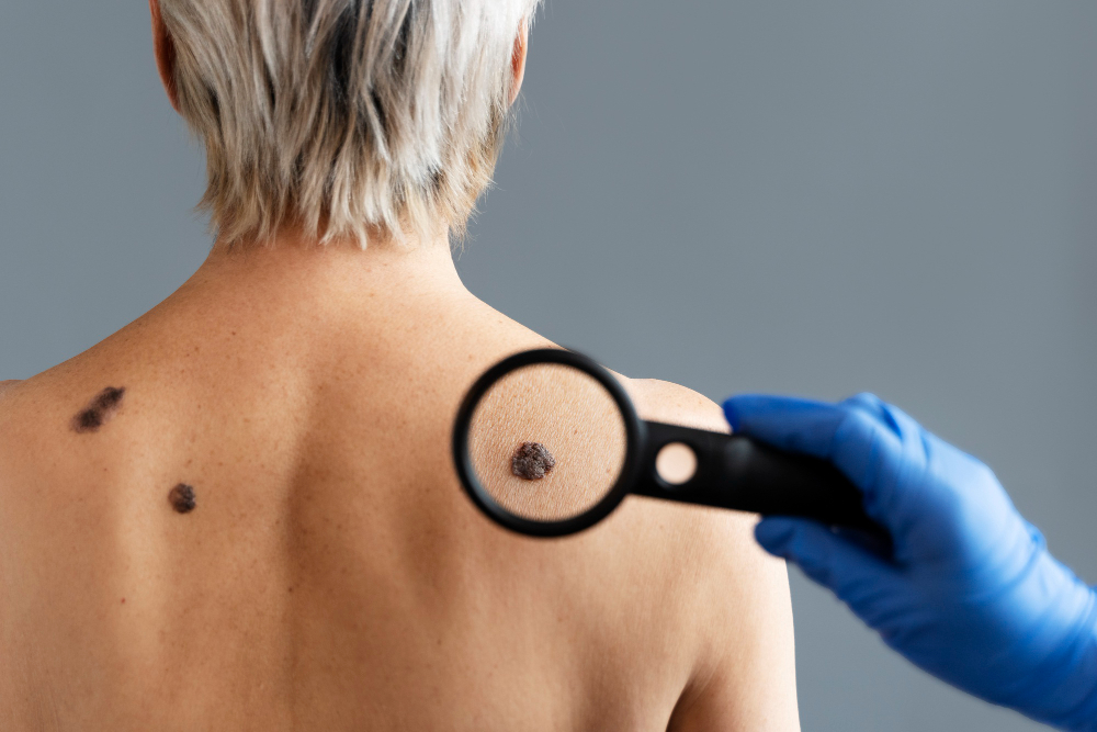O Que É Melanoma? Entenda Esse Câncer de Pele