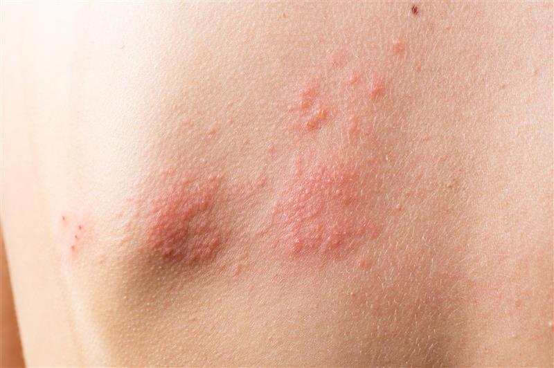 O Que É Herpes-Zóster? Entenda Tudo Sobre A Doença